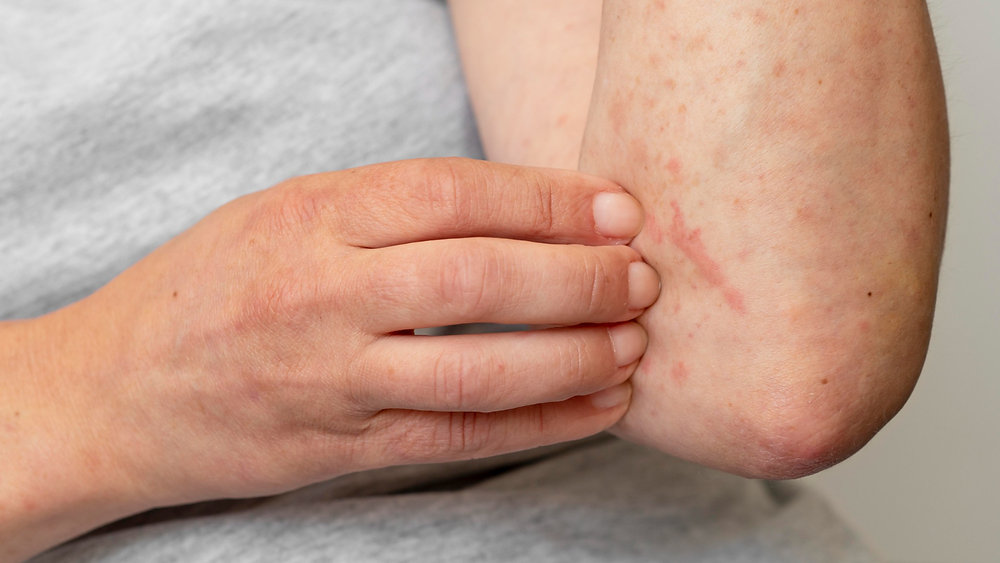 How Do I Know If I Have Bed Bugs: Common Indicators of an Infestation